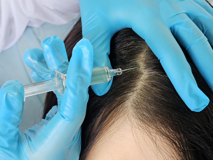Hair restoration Port St Lucie treatments supporting fuller, healthier hair growth.